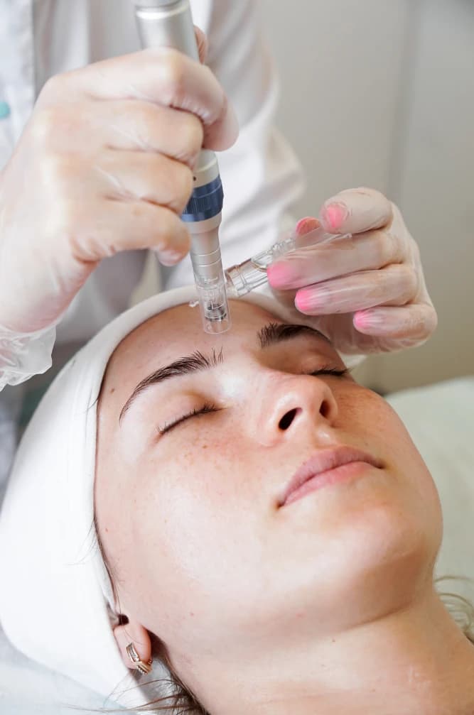 Microneedling Services | Rupi Beauty Studio